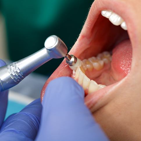 Dental hygienist polishing patient&rsquo;s teeth